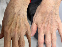 Pigmintation Fix those sun burns and darker skins