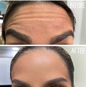BOTOX Dermal Filler Injections