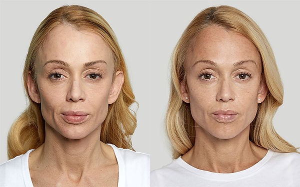 sculptra before and after near me best provider sculptra specials near me in hallandale beach