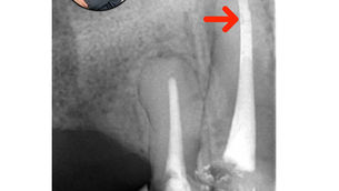 O que são as imagens radiolúcidas de forma esféricas presente nas minhas obturações?