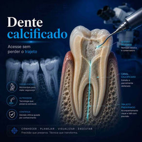 Dente calcificado em corte com trajeto do canal estreito guiado por magnificação e ultrassom.
