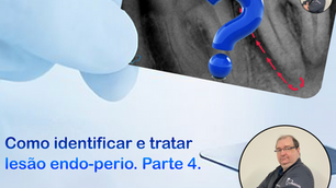 Como identificar e tratar um dente com lesão endo-perio Parte 4- Lesão Perio-endodôntico.