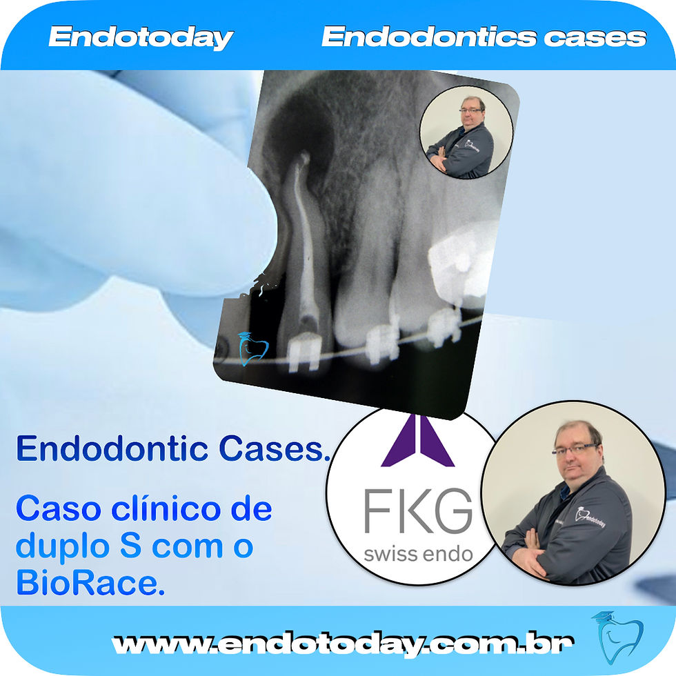 Vencendo a dupla curvatura apical com o sistema BioRace