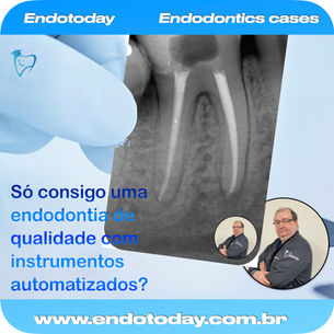 Só consigo uma endodontia de qualidade com instrumentos automatizados?