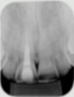 Radiografia inicial de caso de canal atresico