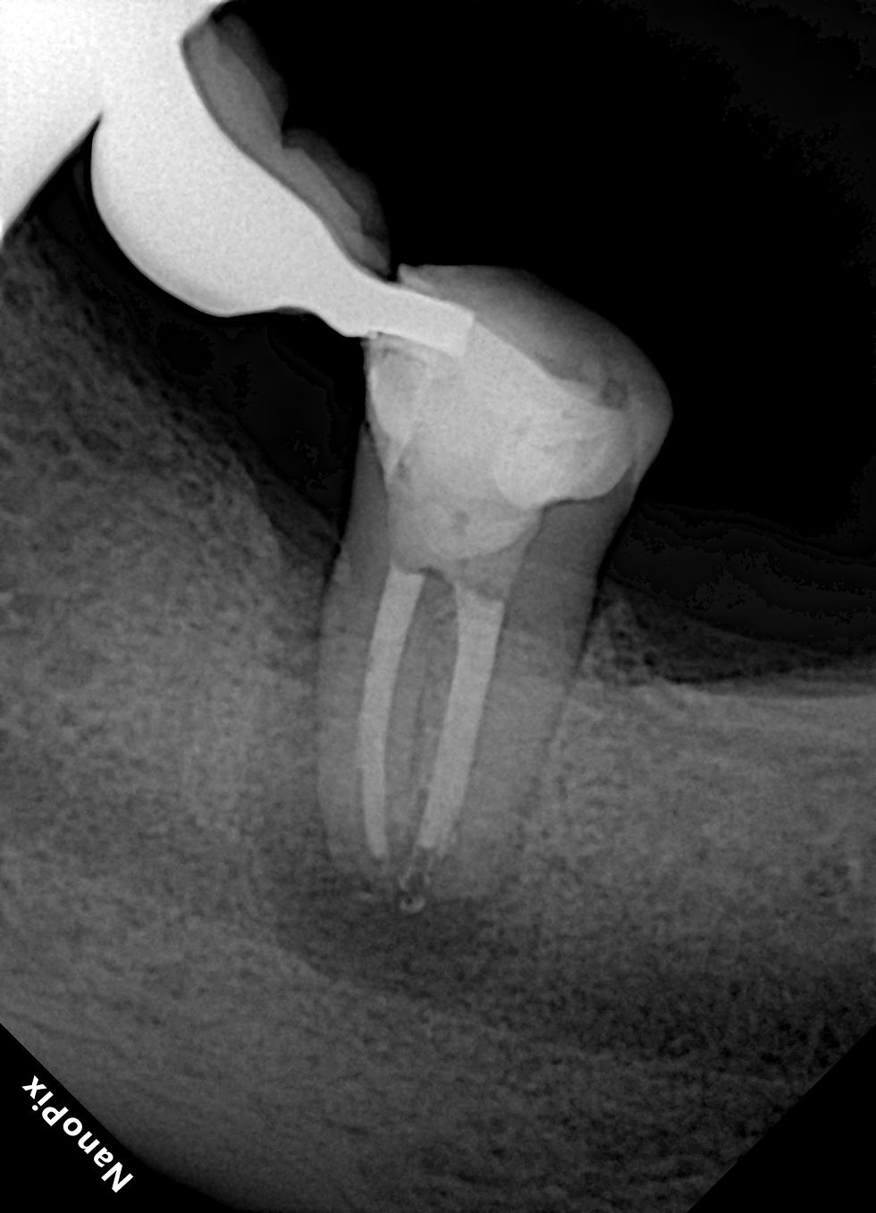 Radiografia Final
