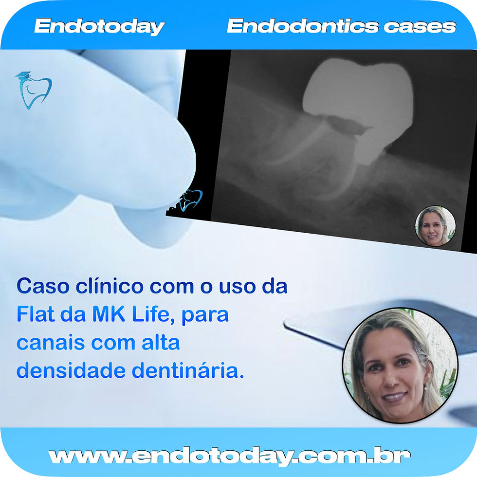 Caso clínico com o uso da Flat da MK Life, para canais com alta densidade dentinária.
