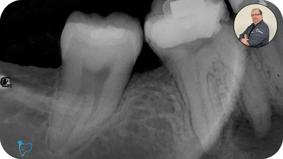 radiografia Inicial de molar 46