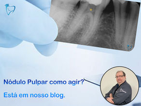 Nódulos pulpares como agir?