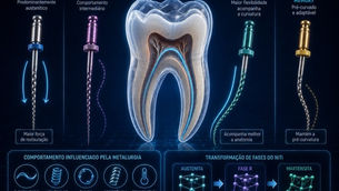 Ligas NiTi e tratamentos térmicos: por que a metalurgia mudou a instrumentação endodôntica