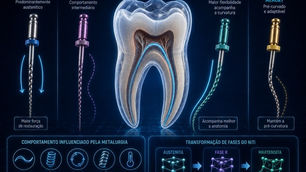 Ligas NiTi e tratamentos térmicos: por que a metalurgia mudou a instrumentação endodôntica