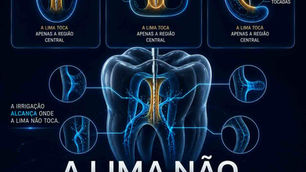 Canais ovais, achatados e em C: por que a lima não toca tudo