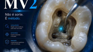 Canal MV2 em molar superior destacado sob microscópio durante abertura coronária.