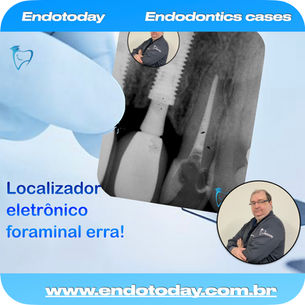 Localizador eletrônico foraminal erra?
