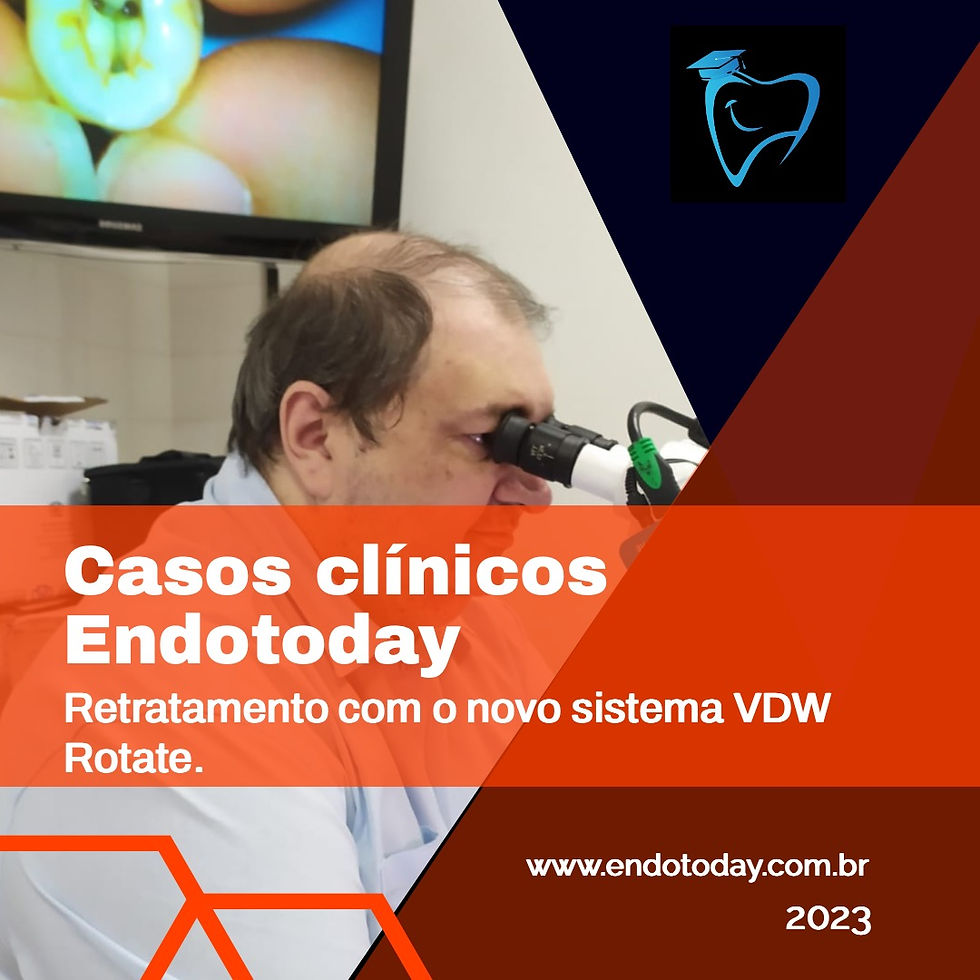 Retratamento e Tratamento endodôntico com o sistema VDW-Rotate