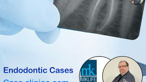 Vencendo canal atrésico com R-pilot (VDW) e Sequence Rotary (MK LIFE).