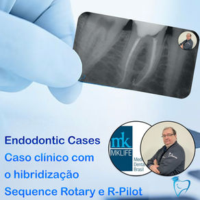 Vencendo canal atrésico com R-pilot (VDW) e Sequence Rotary (MK LIFE).