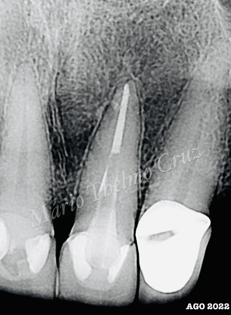 Radiografia de controle após 3 anos.