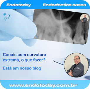Hyflex CM em casos de curvaturas extremas.