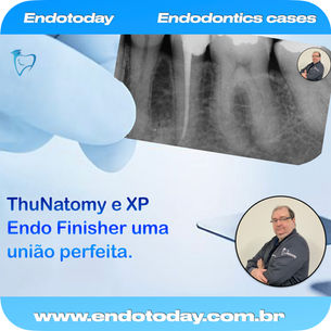 ThuNatomy e XP Endo Finisher uma união perfeita.
