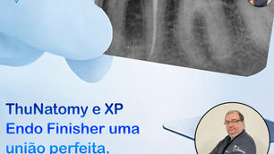 ThuNatomy e XP Endo Finisher uma união perfeita.