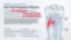 Infográfico de dente em vidro com área vermelha de perigo; texto sobre desgaste, preparo endodôntico e canais radiculares.