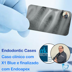 X1 Blue uma das limas mais eficientes da MK Life associado ao sistema Endoapex de Obturação.