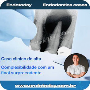 Caso clÃnico de sucesso na endodontia que superou a indicação do implante.