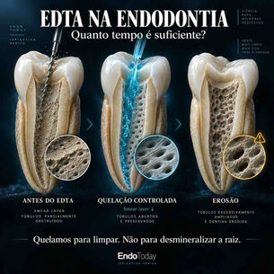 EDTA na Endodontia: concentração, tempo, sequência e erosão dentinária