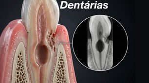 Reabsorções dentárias guia completo
