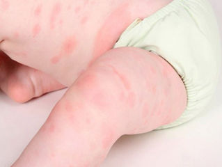 Dị ứng thời tiết ở trẻ em và những điều cần biết
