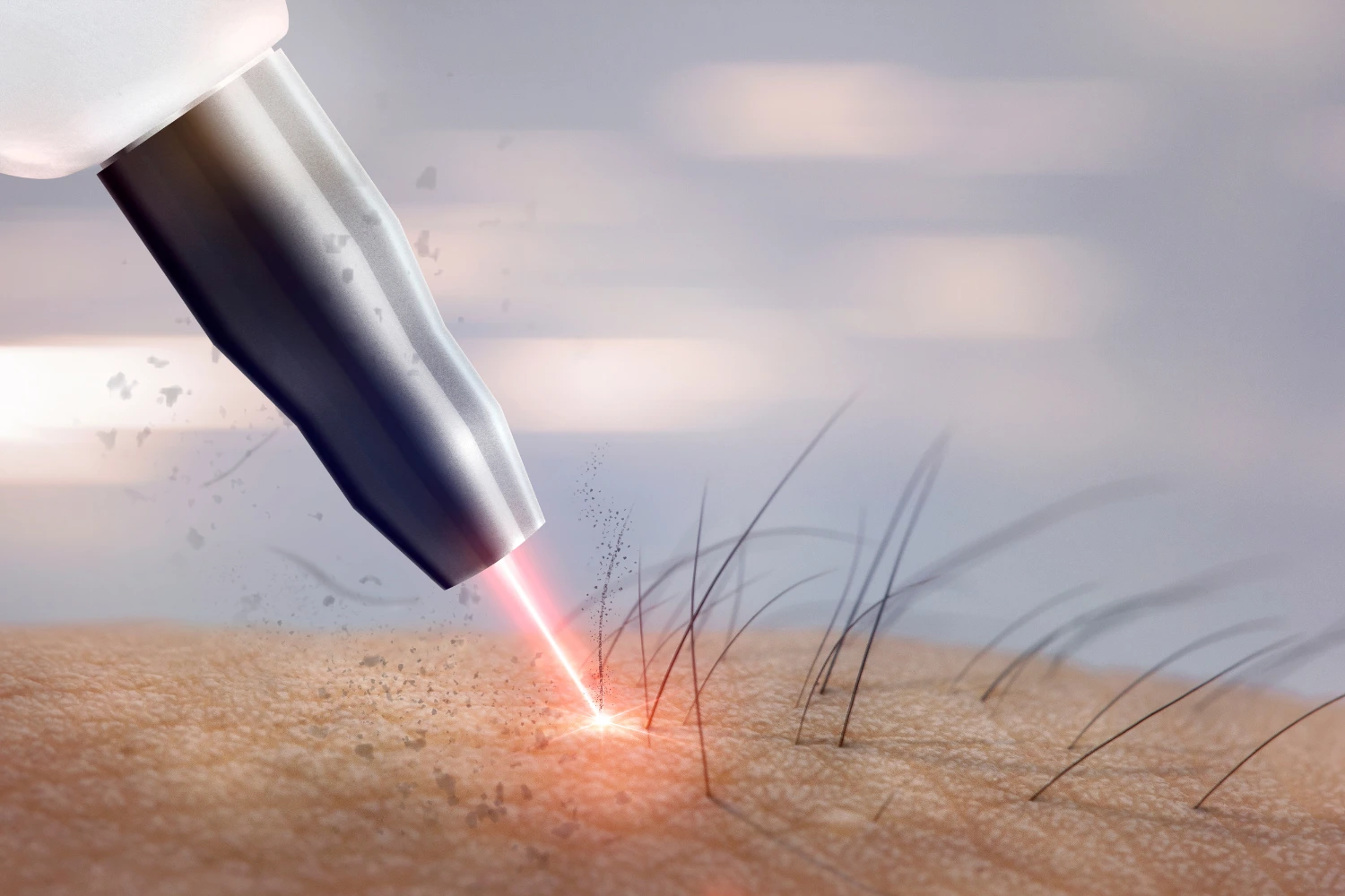 combien de séance épilation laser