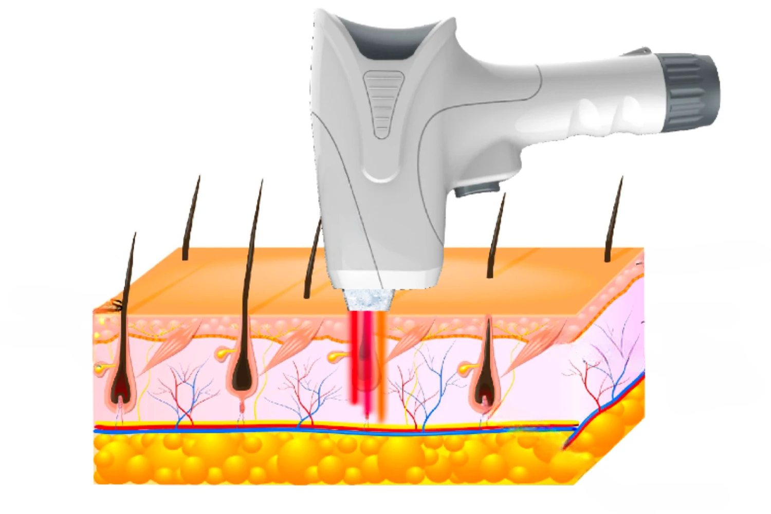 épillation laser classique et laser diode