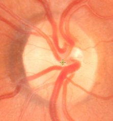 Close up Digital Retinal Image of an Optic Nerve