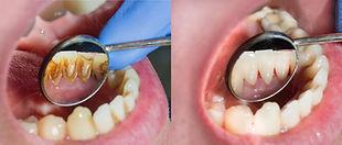 Deantal plaque treatment