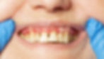 Teeth with periodontitis (gum disease).