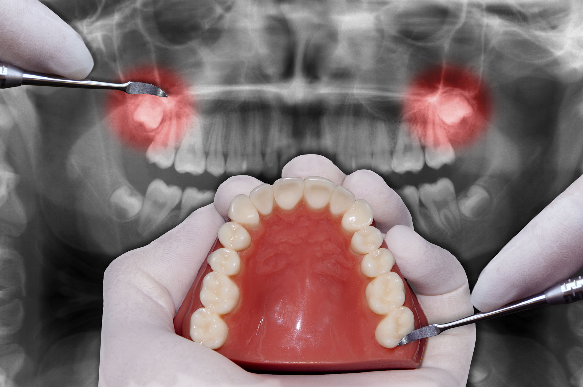 Wisdom teeth removal