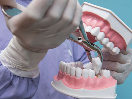 When is a tooth extraction recommended and how do we do it?