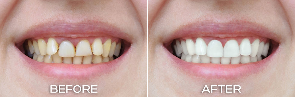 An image of teeth before and after the staightening with clear aligners.