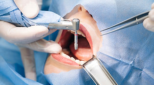 Image showing installation of implant