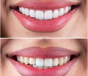 6e-before-and-after-ceramic-restorations.jpg