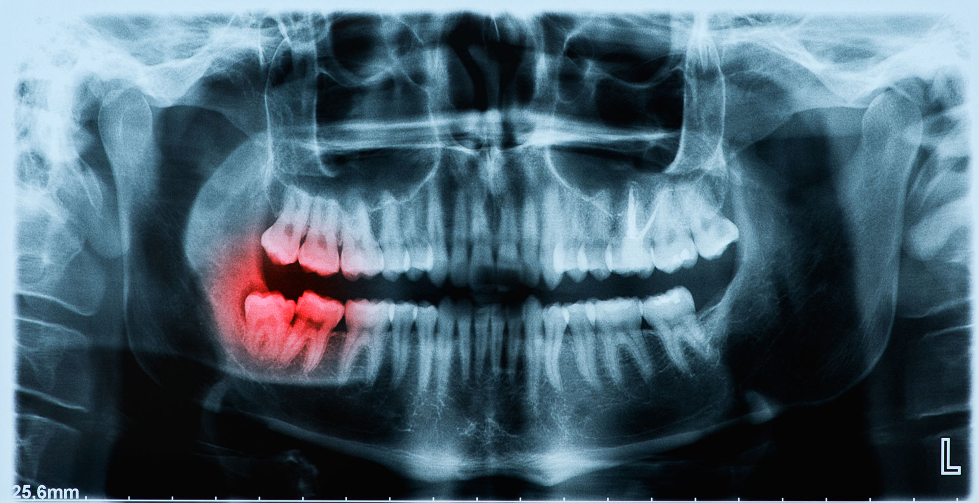 An impacted tooth