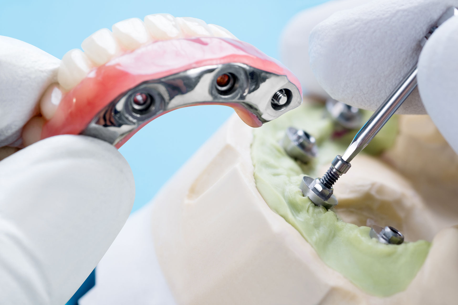 Denist screws in an abutment into the implant.