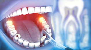 Image showing removal of a damaged tooth