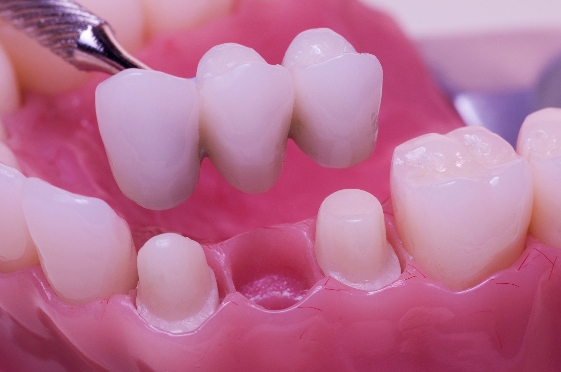Image of a dental bridge.