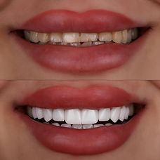 Smile design treatment woman