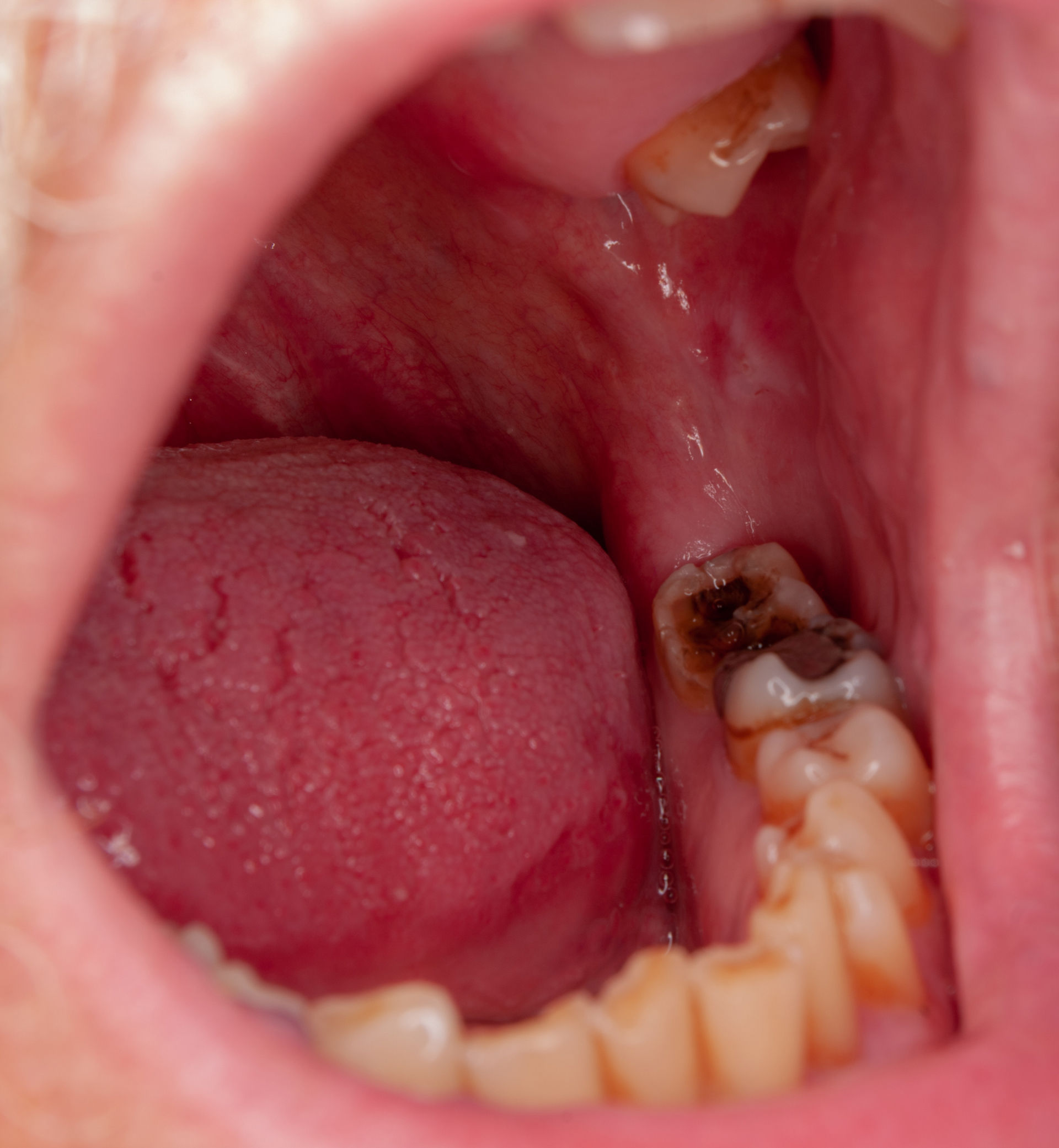 Severe tooth decay (cavities)