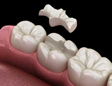 Cerec inlay.