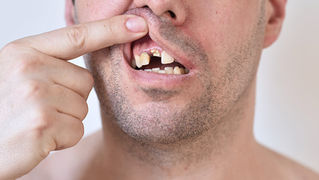Missing tooth.