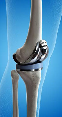 knee replacement